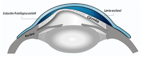 lentes esclerales