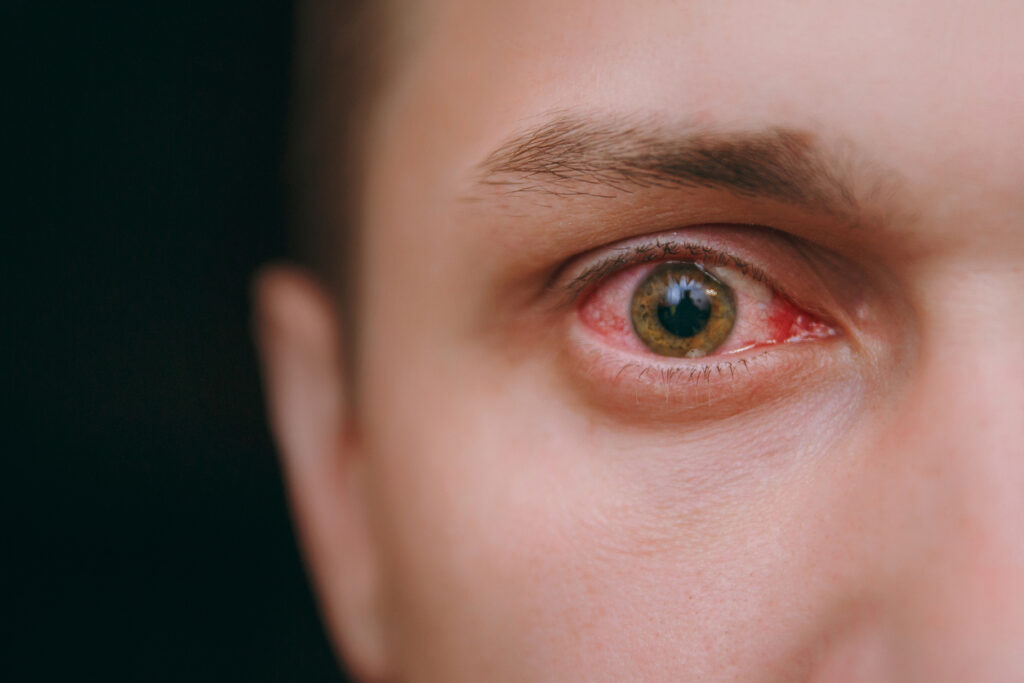ojo irritado